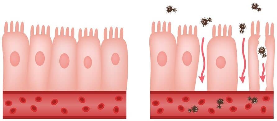 Diagram showing the difference between healthy intestines and intestines affected by Leaky Gut Syndrome. The left side of the image displays healthy intestinal lining with tightly packed cells, preventing bacteria and toxins from entering the bloodstream. The right side illustrates Leaky Gut Syndrome, where the intestinal cells are damaged and gaps allow harmful bacteria and toxins to pass through, entering the bloodstream.